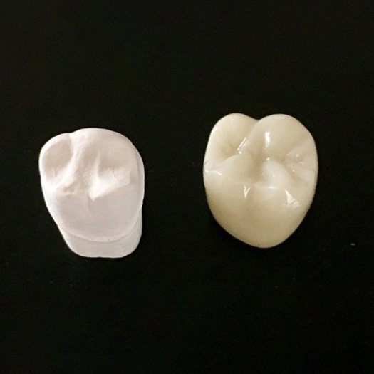 Porcelain crown prior to placement