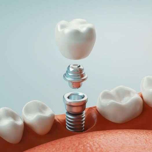 Illustrated model of dental implant replacing a missing tooth