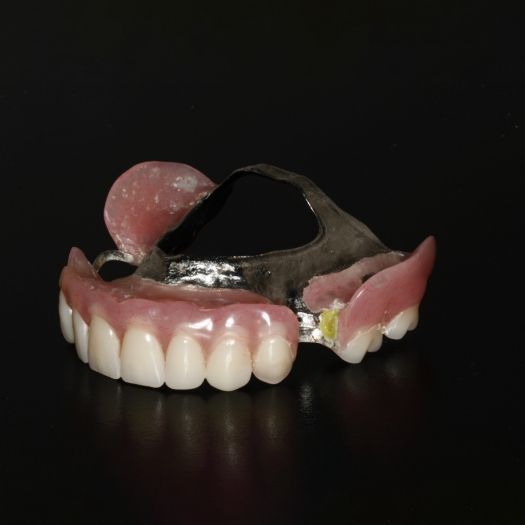Upper partial denture