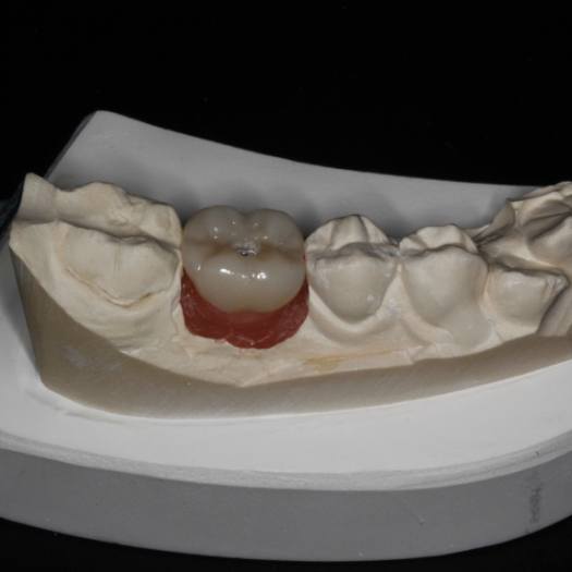 Closeup of tooth-colored fillings