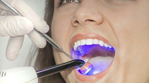 Dental patient having a tooth colored filling hardened