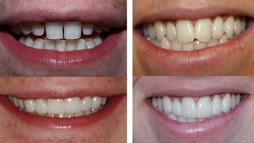 Collage of smiles before and after being transformed with veneers