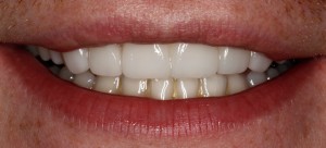 McCarl Patient after thin porcelain veneers McCarl Patient after thin veneers