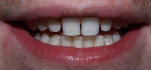McCarl Patient before thin porcelain veneers McCarl Patient before no prep veneers