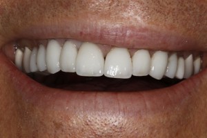 Severna Park Dental Patient Pain Free after Same Day Dental Emergency Care