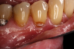 Tooth colored fillings can repair this root caries before it becomes too advanced