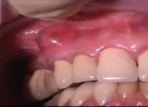 Tooth Abscess Before Dental Treatment 