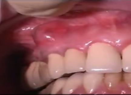 Tooth abscess 2
