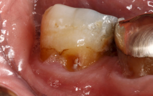 Root caries on a lower molar
