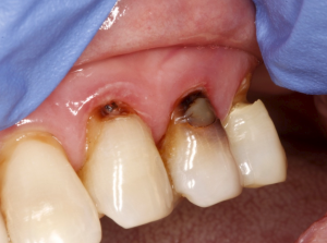 Root caries on lateral incisor, canine and first bicuspid