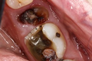 Severley Broken Teeth Requiring RC & Crown from McCarl Dental group the emergency dentist greenbelt trusts