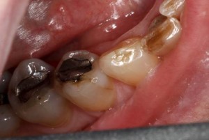 Teeth grinding damage needs nightguards from mccarl dental