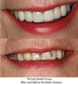 After and Before Porcelain Veneers