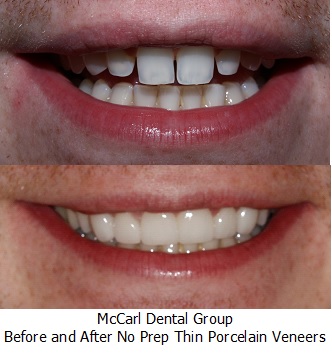 Before - After No Prep Veneers