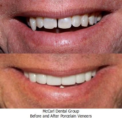 Before - After Poreclain Veneers