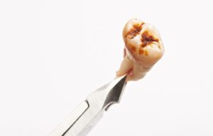 Extracted tooth with extensive decay