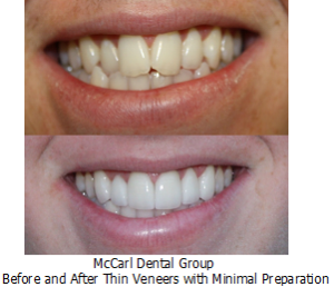 Before - After Minimal Prep Thin Veneers