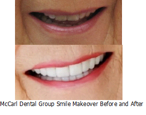 Before - After Smile Makeover