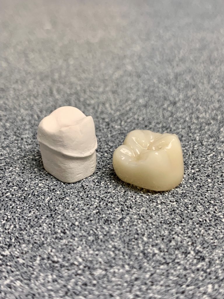 Dental crown restoration model