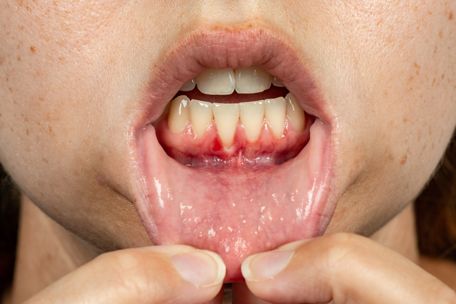 Closeup of smile with damaged and receding gum tissue