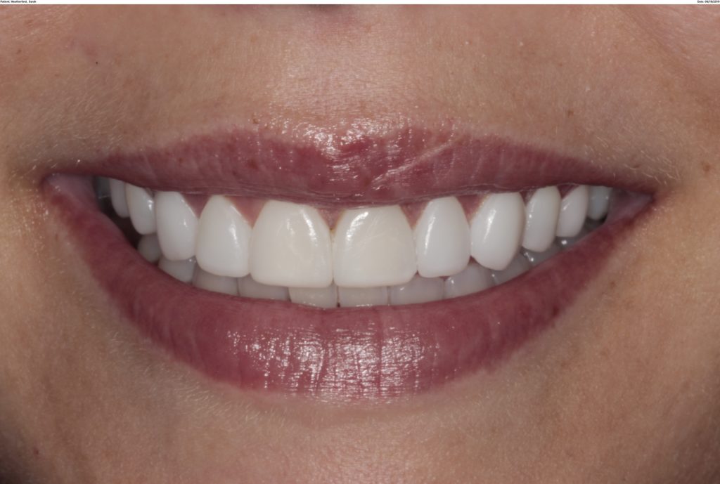 Veneers by Dr. Clayton McCarl