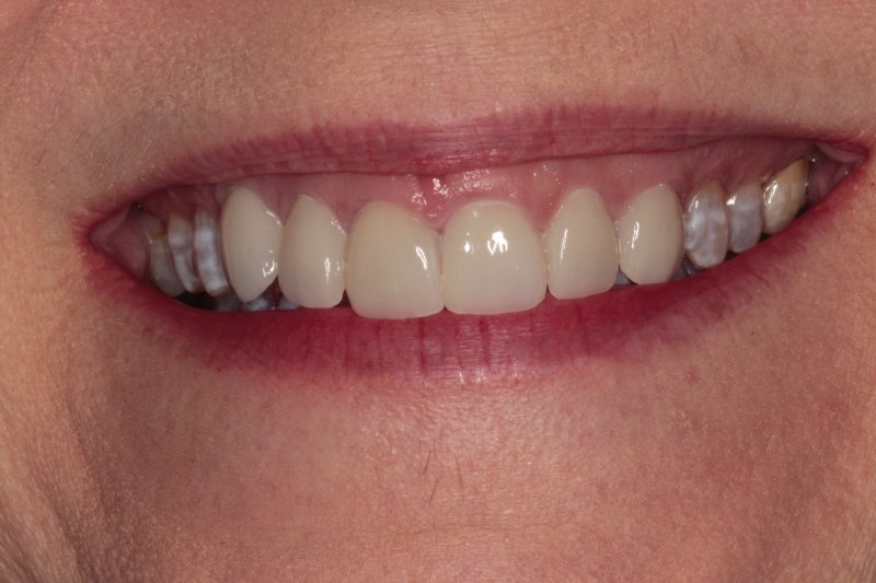 patient with veneers